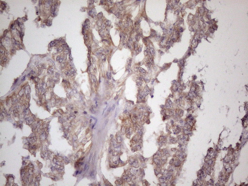 Immunohistochemical staining of paraffin-embedded Adenocarcinoma of Human endometrium tissue using anti-BMF mouse monoclonal antibody