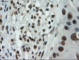Immunohistochemical staining of paraffin-embedded Carcinoma of Human lung tissue using anti-IL-3 mouse monoclonal antibody