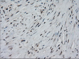 Immunohistochemical staining of paraffin-embedded Carcinoma of Human pancreas tissue using anti-IL-3 mouse monoclonal antibody