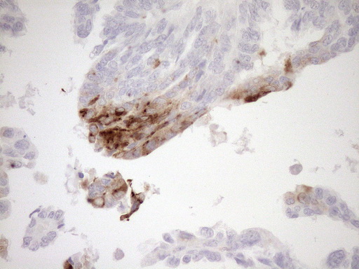 Immunohistochemical staining of paraffin-embedded Adenocarcinoma of Human ovary tissue using anti-GPNMB mouse monoclonal antibody