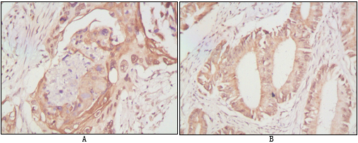 Immunohistochemistry analysis of paraffin-embedded human lung cancer (A) and rectal cancer (B), showing cytoplasmic localization with DAB staining using DDX4 Monoclonal Antibody