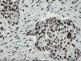 Immunohistochemical staining of paraffin-embedded Carcinoma of Human lung tissue using anti-TLE1 mouse monoclonal antibody