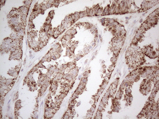 Immunohistochemical staining of paraffin-embedded Adenocarcinoma of Human ovary tissue using anti-C19ORF80 mouse monoclonal antibody