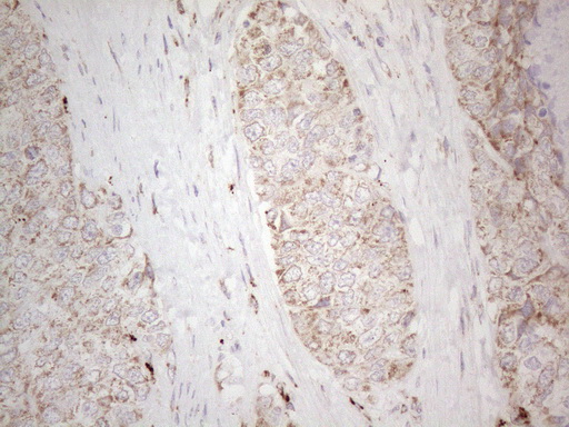 Immunohistochemical staining of paraffin-embedded Adenocarcinoma of Human endometrium tissue using anti-C19ORF80 mouse monoclonal antibody