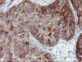 Immunohistochemical staining of paraffin-embedded Adenocarcinoma of Human ovary tissue using anti-SDCBP mouse monoclonal antibody