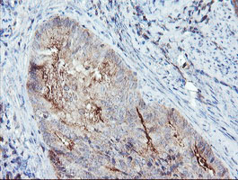 Immunohistochemical staining of paraffin-embedded Adenocarcinoma of Human endometrium tissue using anti-SDCBP mouse monoclonal antibody
