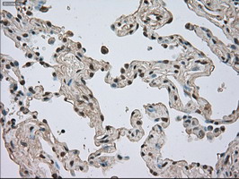 Immunohistochemical staining of paraffin-embedded Carcinoma of Human lung tissue using anti-NTRK3 mouse monoclonal antibody