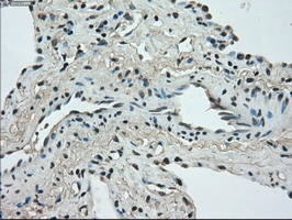Immunohistochemical staining of paraffin-embedded Carcinoma of Human lung tissue using anti-STK39 mouse monoclonal antibody