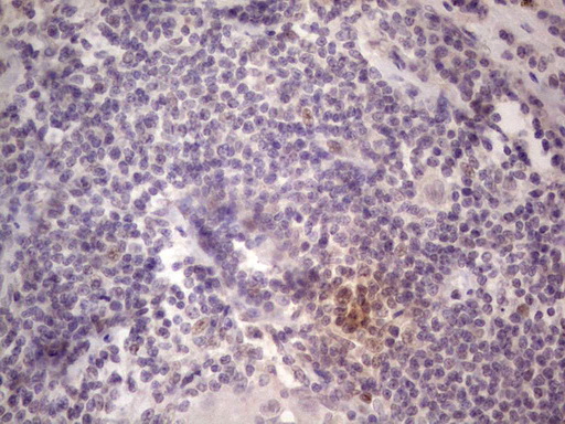 Immunohistochemical staining of paraffin-embedded Carcinoma of Human lung tissue using anti-TCF12 mouse monoclonal antibody