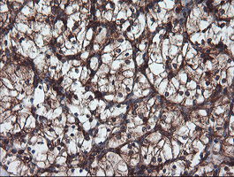 Immunohistochemical staining of paraffin-embedded Carcinoma of Human kidney tissue using anti-USP9X mouse monoclonal antibody
