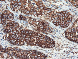 Immunohistochemical staining of paraffin-embedded Adenocarcinoma of Human ovary tissue using anti-USP9X mouse monoclonal antibody