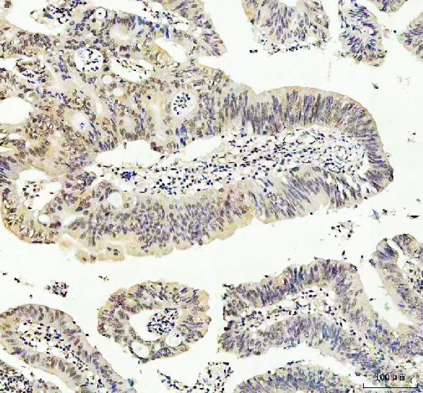 Figure 2. IHC analysis of JNK1/MAPK8 using anti-JNK1/MAPK8 antibody (M02608-3). JNK1/MAPK8 was detected in a paraffin-embedded section of human colorectal adenocarcinoma tissue. Heat mediated antigen retrieval was performed in EDTA buffer (pH 8.0, epitope retrieval solution). The tissue section was blocked with 10% goat serum. The tissue section was then incubated with 1:50 rabbit anti-JNK1/MAPK8 Antibody (M02608-3) overnight at 4°C. Peroxidase Conjugated Goat Anti-rabbit IgG was used as secondary antibody and incubated for 30 minutes at 37°C. The tissue section was developed using HRP Conjugated Rabbit IgG Super Vision Assay Kit (Catalog # SV0002) with DAB as the chromogen.