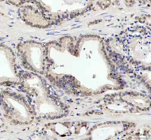 Figure 5. IHC analysis of JNK1/MAPK8 using anti-JNK1/MAPK8 antibody (M02608-3). JNK1/MAPK8 was detected in a paraffin-embedded section of human prostate cancer tissue. Heat mediated antigen retrieval was performed in EDTA buffer (pH 8.0, epitope retrieval solution). The tissue section was blocked with 10% goat serum. The tissue section was then incubated with 1:50 rabbit anti-JNK1/MAPK8 Antibody (M02608-3) overnight at 4°C. Peroxidase Conjugated Goat Anti-rabbit IgG was used as secondary antibody and incubated for 30 minutes at 37°C. The tissue section was developed using HRP Conjugated Rabbit IgG Super Vision Assay Kit (Catalog # SV0002) with DAB as the chromogen.