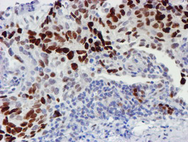 Immunohistochemical staining of paraffin-embedded Carcinoma of Human lung tissue using anti-WWTR1 mouse monoclonal antibody