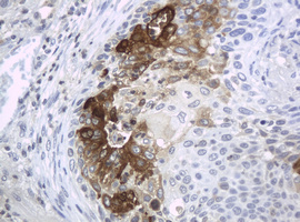 Immunohistochemical staining of paraffin-embedded Carcinoma of Human lung tissue using anti-WFDC2 mouse monoclonal antibody