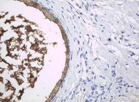 Immunohistochemical staining of paraffin-embedded Carcinoma of Human prostate tissue using anti-WFDC2 mouse monoclonal antibody