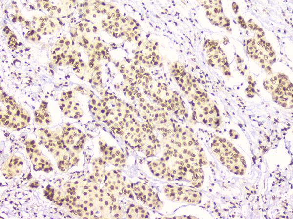 IHC analysis of RbAp48 using anti-RbAp48 antibody (M02702-1). RbAp48 was detected in paraffin-embedded section of human mammary cancer tissues. Heat mediated antigen retrieval was performed in citrate buffer (pH6, epitope retrieval solution) for 20 mins. The tissue section was blocked with 10% goat serum. The tissue section was then incubated with 1μg/ml mouse anti-RbAp48 Antibody (M02702-1) overnight at 4°C. Biotinylated goat anti-mouse IgG was used as secondary antibody and incubated for 30 minutes at 37°C. The tissue section was developed using Strepavidin-Biotin-Complex (SABC)(Catalog # SA1021) with DAB as the chromogen.