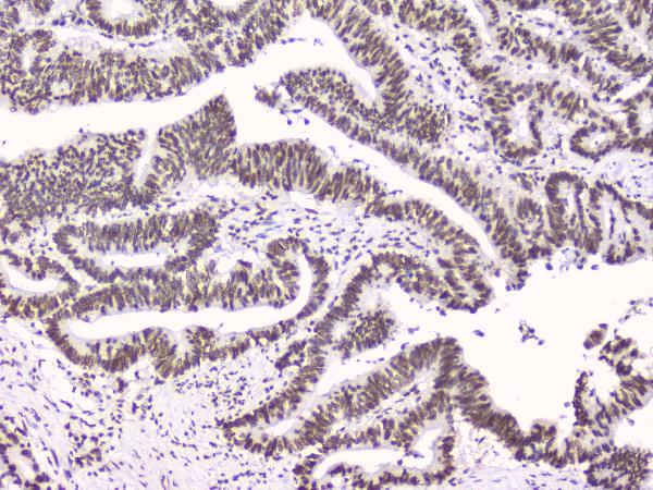 IHC analysis of RbAp48 using anti-RbAp48 antibody (M02702-1). RbAp48 was detected in paraffin-embedded section of human intestinal cancer tissues. Heat mediated antigen retrieval was performed in citrate buffer (pH6, epitope retrieval solution) for 20 mins. The tissue section was blocked with 10% goat serum. The tissue section was then incubated with 1μg/ml mouse anti-RbAp48 Antibody (M02702-1) overnight at 4°C. Biotinylated goat anti-mouse IgG was used as secondary antibody and incubated for 30 minutes at 37°C. The tissue section was developed using Strepavidin-Biotin-Complex (SABC)(Catalog # SA1021) with DAB as the chromogen.