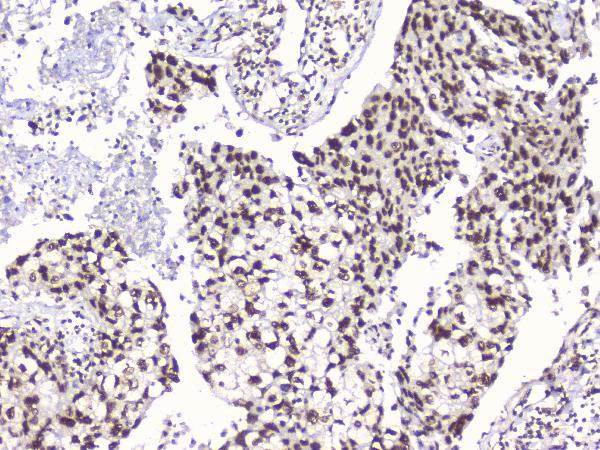 IHC analysis of RbAp48 using anti-RbAp48 antibody (M02702-1). RbAp48 was detected in paraffin-embedded section of human lung cancer tissues. Heat mediated antigen retrieval was performed in citrate buffer (pH6, epitope retrieval solution) for 20 mins. The tissue section was blocked with 10% goat serum. The tissue section was then incubated with 1μg/ml mouse anti-RbAp48 Antibody (M02702-1) overnight at 4°C. Biotinylated goat anti-mouse IgG was used as secondary antibody and incubated for 30 minutes at 37°C. The tissue section was developed using Strepavidin-Biotin-Complex (SABC)(Catalog # SA1021) with DAB as the chromogen.