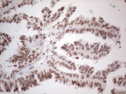Immunohistochemical staining of paraffin-embedded Adenocarcinoma of Human ovary tissue using anti-NR2C2 mouse monoclonal antibody