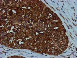 Immunohistochemical staining of paraffin-embedded Adenocarcinoma of Human ovary tissue using anti-GATM mouse monoclonal antibody
