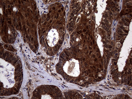 Immunohistochemical staining of paraffin-embedded Adenocarcinoma of Human ovary tissue using anti-TSN mouse monoclonal antibody