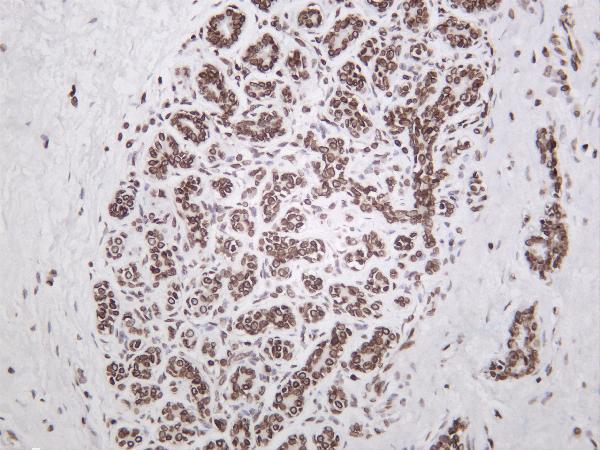 Human breast carcinoma was stained with anti-Lamin B1 rabbit antibody