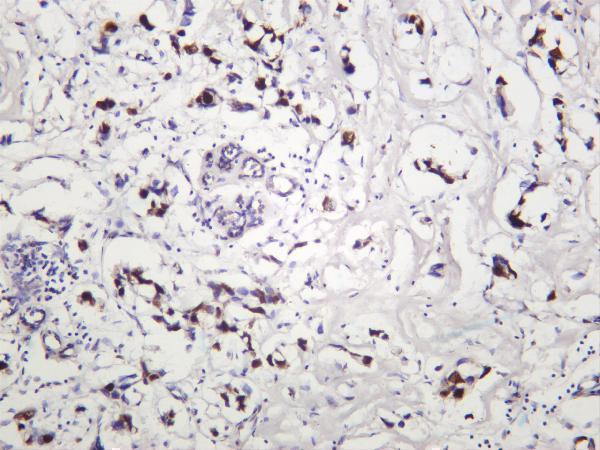 Human breast carcinoma was stained with anti-HP1α rabbit antibody