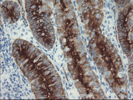 Immunohistochemical staining of paraffin-embedded Adenocarcinoma of Human endometrium tissue using anti-FOLH1 mouse monoclonal antibody