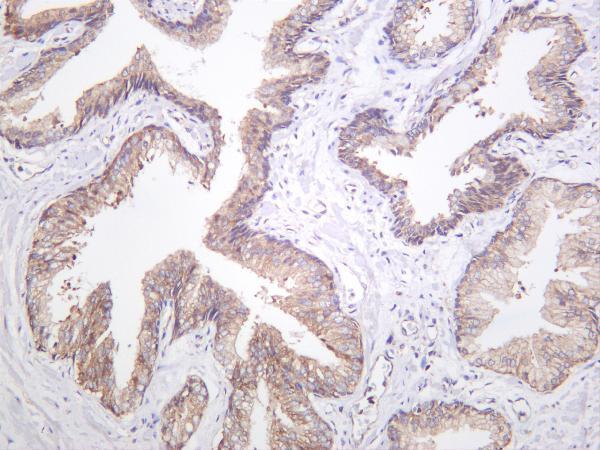 Human prostate carcinoma was stained with anti-Prostate Specific Membrane Antigen (PSMA) rabbit antibody