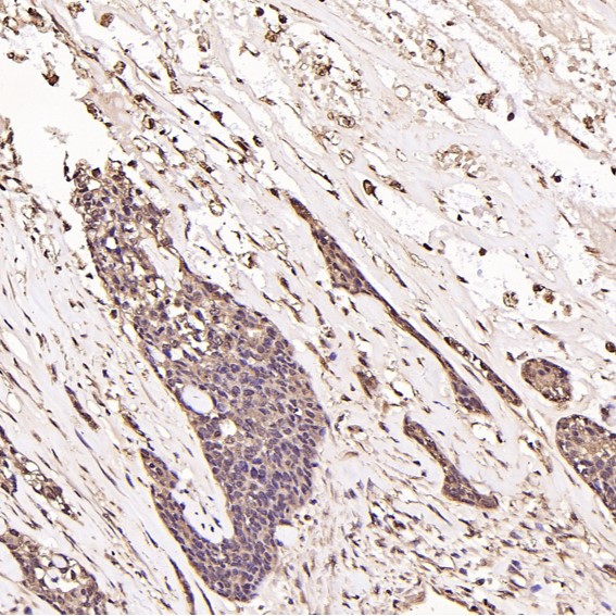 Immunohistochemical analysis of paraffin-embedded Human breast cancer, using the Antibody at 1:250 dilution.