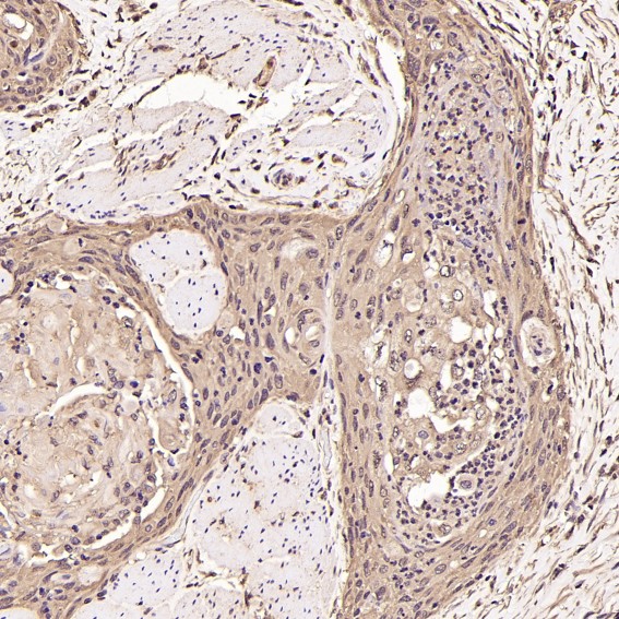 Immunohistochemical analysis of paraffin-embedded Human esophageal carcinoma, using the Antibody at 1:250 dilution.
