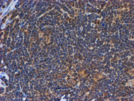 Immunohistochemical staining of paraffin-embedded Human lymphoma tissue using anti-PSMB9 mouse monoclonal antibody