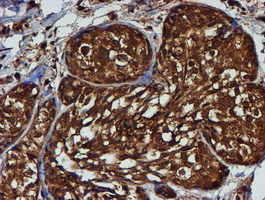 Immunohistochemical staining of paraffin-embedded Adenocarcinoma of Human breast tissue using anti-PSMB9 mouse monoclonal antibody