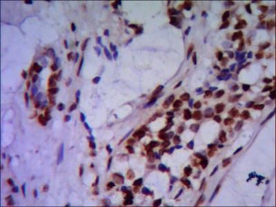 Immunohistochemistry stain of paraffin-embedded human breast cancer using PRMT6 antibody (1:200)