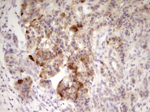 Immunohistochemical staining of paraffin-embedded Carcinoma of Human pancreas tissue using anti-ANGPTL3 mouse monoclonal antibody