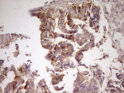 Immunohistochemical staining of paraffin-embedded Adenocarcinoma of Human colon tissue using anti-ANGPTL3 mouse monoclonal antibody