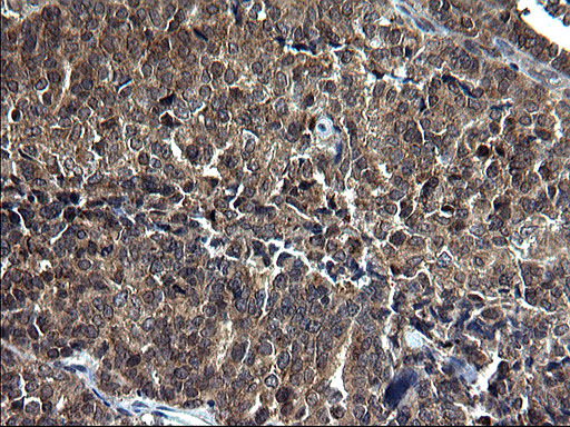 Immunohistochemical staining of paraffin-embedded Adenocarcinoma of Human endometrium tissue using anti-SCP2 mouse monoclonal antibody