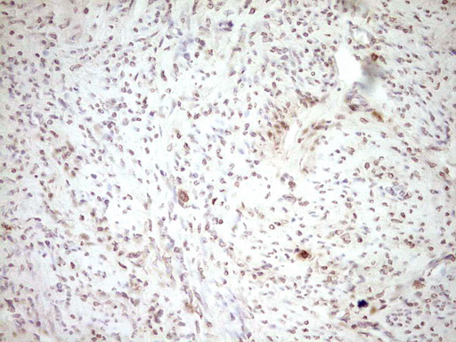 Immunohistochemical staining of paraffin-embedded Adenocarcinoma of Human endometrium tissue using anti-PLAT mouse monoclonal antibody