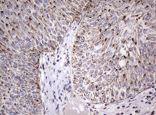 Immunohistochemical staining of paraffin-embedded Carcinoma of Human bladder tissue using anti-ADAMTS1 mouse monoclonal antibody
