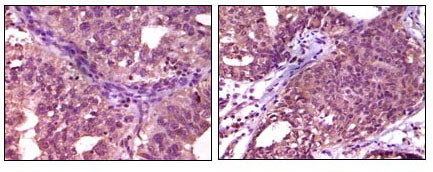Immunohistochemistry analysis of paraffin-embedded human ovary carcinoma (left) and breast carcinoma (right), showing cytoplasmic localization with DAB staining using EphA1 Monoclonal Antibody
