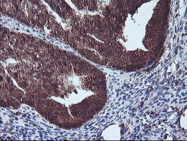 Immunohistochemical staining of paraffin-embedded Adenocarcinoma of Human endometrium tissue using anti-NLN mouse monoclonal antibody