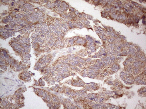 Immunohistochemical staining of paraffin-embedded Adenocarcinoma of Human ovary tissue using anti-ABCC5 mouse monoclonal antibody