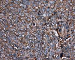 Immunohistochemical staining of paraffin-embedded Adenocarcinoma of Human ovary tissue using anti-PIM2 mouse monoclonal antibody