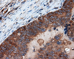 Immunohistochemical staining of paraffin-embedded Adenocarcinoma of ovary tissue using anti-PIM2 mouse monoclonal antibody