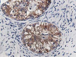 Immunohistochemical staining of paraffin-embedded Adenocarcinoma of Human ovary tissue using anti-OSBP mouse monoclonal antibody
