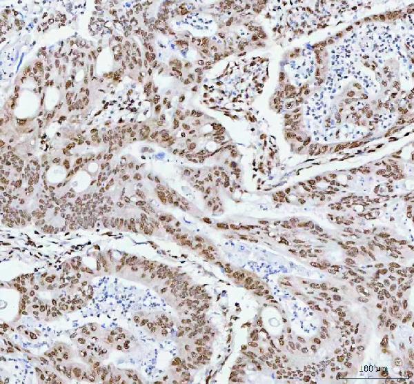 Figure 2. IHC analysis of RBM3 using anti-RBM3 antibody (M03104). RBM3 was detected in a paraffin-embedded section of human colorectal adenocarcinoma tissue. Heat mediated antigen retrieval was performed in EDTA buffer (pH 8.0, epitope retrieval solution). The tissue section was blocked with 10% goat serum. The tissue section was then incubated with 1:50 rabbit anti-RBM3 Antibody (M03104) overnight at 4°C. Peroxidase Conjugated Goat Anti-rabbit IgG was used as secondary antibody and incubated for 30 minutes at 37°C. The tissue section was developed using HRP Conjugated Rabbit IgG Super Vision Assay Kit (Catalog # SV0002) with DAB as the chromogen. Figure 2. IHC analysis of RBM3 using anti-RBM3 antibody (M03104). RBM3 was detected in a paraffin-embedded section of human colorectal adenocarcinoma tissue. Heat mediated antigen retrieval was performed in EDTA buffer (pH 8.0, epitope retrieval solution). The tissue section was blocked with 10% goat serum. The tissue section was then incubated with 1:50 rabbit anti-RBM3 Antibody (M03104) overnight at 4°C. Peroxidase Conjugated Goat Anti-rabbit IgG was used as secondary antibody and incubated for 30 minutes at 37°C. The tissue section was developed using HRP Conjugated Rabbit IgG Super Vision Assay Kit (Catalog # SV0002) with DAB as the chromogen.