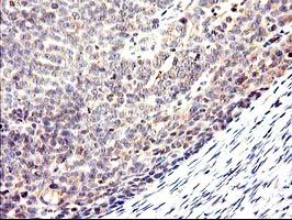 Immunohistochemical staining of paraffin-embedded Adenocarcinoma of Human ovary tissue using anti-CYP2J2 mouse monoclonal antibody