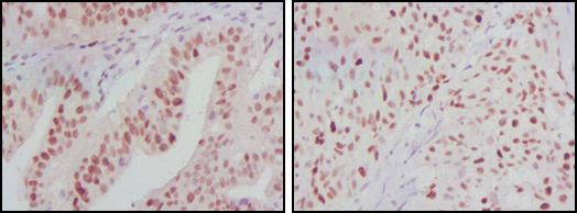 Immunohistochemistry analysis of paraffin-embedded human ovarian cancer (left) and breast cancer (right) tissues with DAB staining using PMR1 Monoclonal Antibody