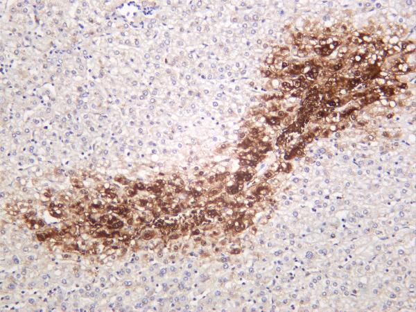 Human hepatocellular carcinoma was stained with anti-Glutamine Synthetase rabbit antibody